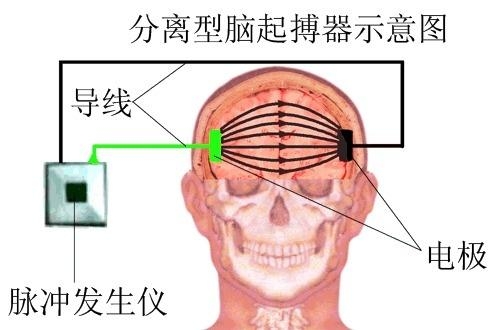 山東癲癇最新治療方法的研究與應(yīng)用進展